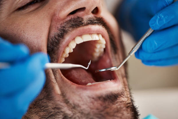 Best Emergency Root Canal Treatment in Essex Junction, VT
